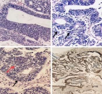 A Rare Case of High-Grade Non-intestinal Sinonasal Adenocarcinoma