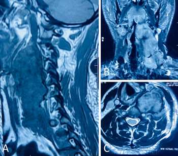 Biphenotypic Spindle Cell Sarcoma: First Report of an Ectopic Occurrence in the Parapharyngeal Space