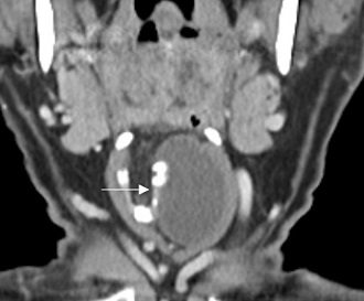 Midline Branchial Cleft Cyst Initially Misdiagnosed as a Thyroglossal Duct Cyst: A Rare Case Study and Literature Review