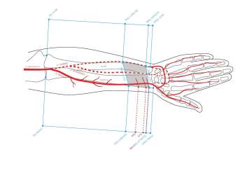 Chimeric Radial Forearm Flap With Pronator Quadratus Muscle for Facial Reanimation: An Anatomical Feasibility Study