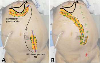 Microsurgical Lymphatic Reconstruction for Refractory Chylous Ascites in Systemic Lupus Erythematosus: Case Report and Literature Review