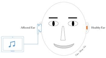 Neuroplastic Effect of Constraint-Induced Music Therapy on Hearing Recovery in Patients with Sudden Sensorineural Hearing Loss