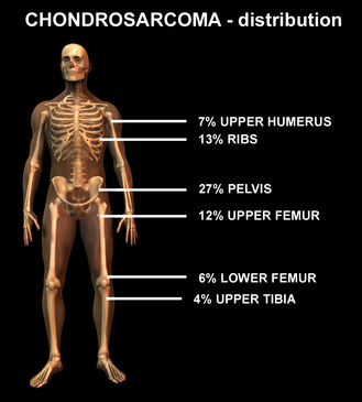 Head and Neck Juxtacortical Chondrosarcoma