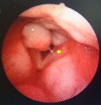 Assessment and Management of Laryngopharyngeal Reflux