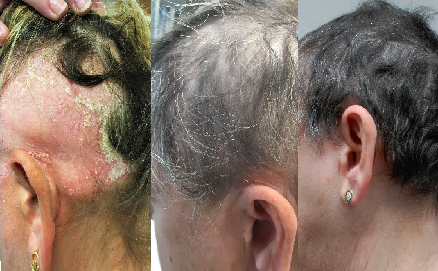 Alopecia Areata and Severe Psoriasis Successfully Treated with Apremilast