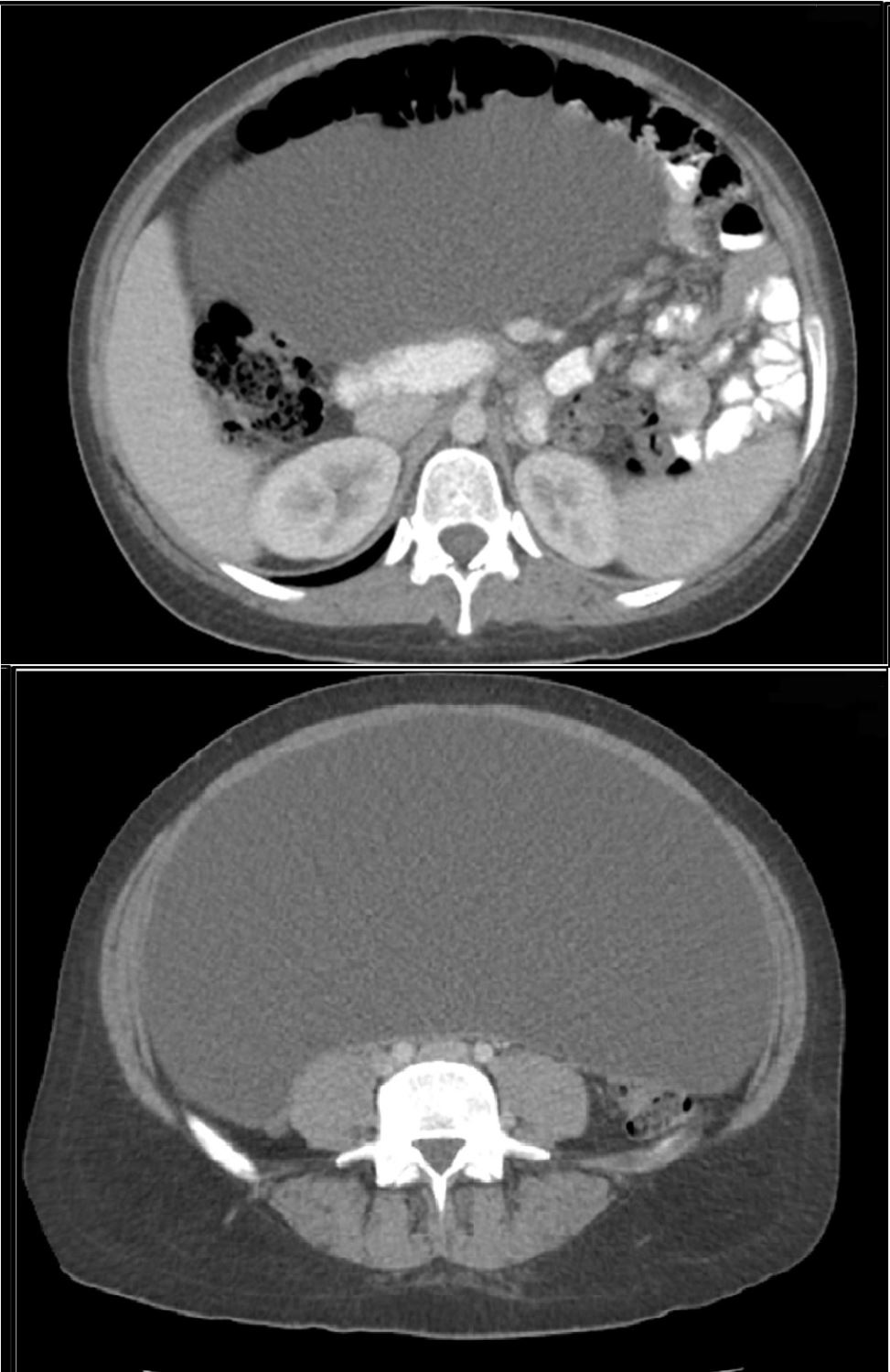 Management of a Giant Cystic Mass in a Young Otherwise Healthy Woman