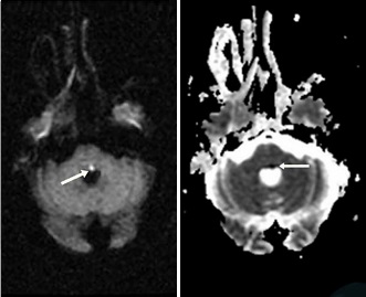 Eight-and-a-Half Syndrome Presented with Trigeminal Neuralgia