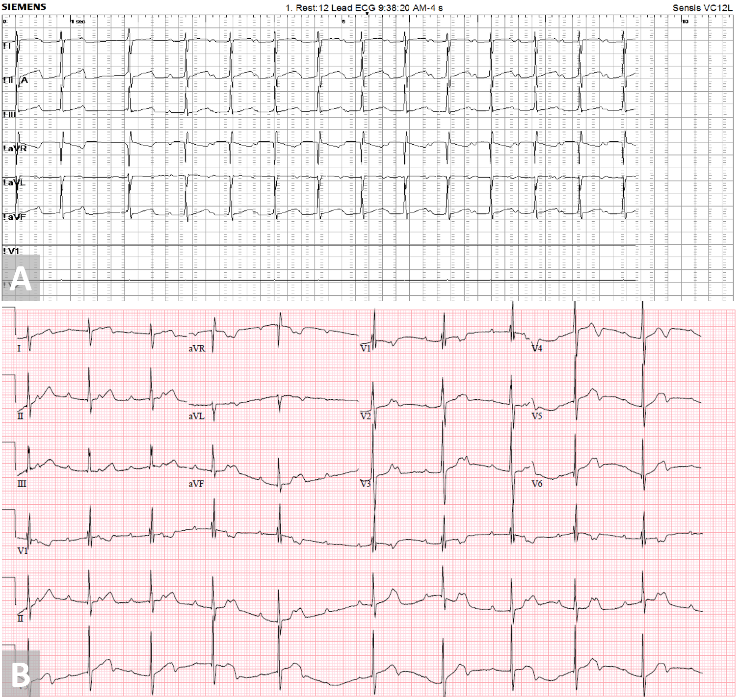 Early Progressive Atrioventricular Block After Amplatzer Septal Occluder Closure of a Large Atrial Septal Defect