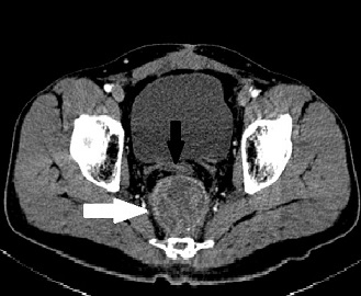 Asymptomatic Rectal Perforation After Radiation for Rectal Cancer: A Diagnostic Dilemma and Role of MRI