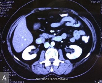 Aberrant Renal Vessels