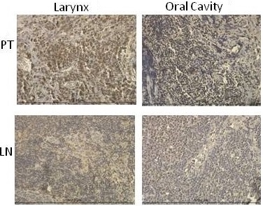 Presence and Quantity of COX-2 in Lymph Node Metastases 