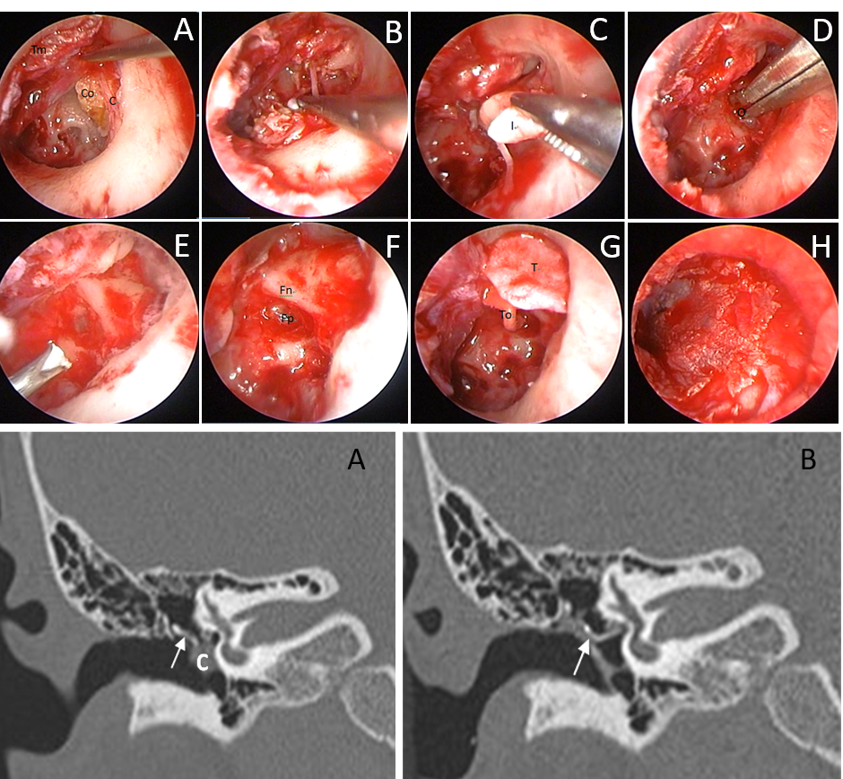 Transcanal Endoscopic Ear Surgery for Congenital Cholesteatoma: 