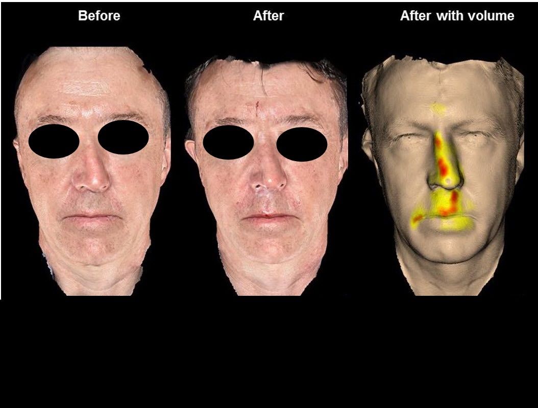 Nasal Aging and Rejuvenation