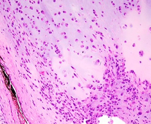 Head and Neck Juxtacortical Chondrosarcoma: A Systematic Review