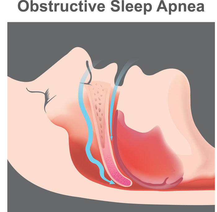 Voice, Cough, and Diurnal Breathing Problems and Quality of Life in Obstructive Sleep Apnea