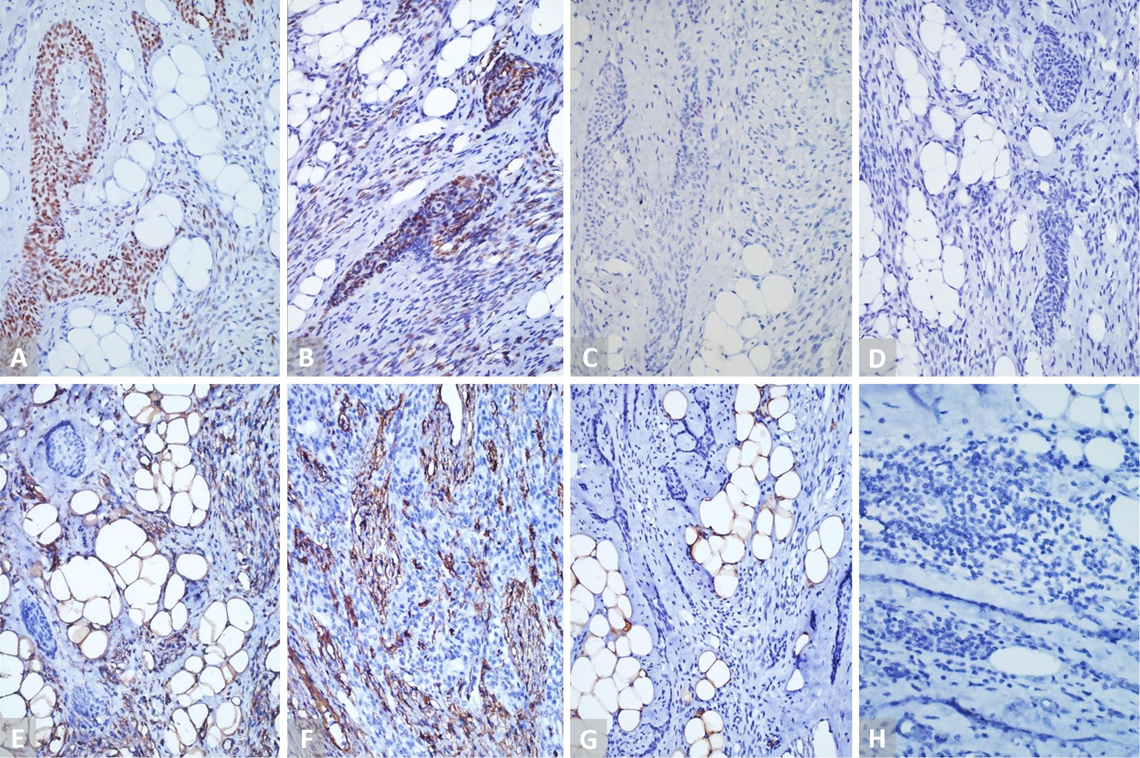 Need for Re-classifying the Rare Condition of Ectopic Hamartomatous Thymoma Based on Tumor Analysis