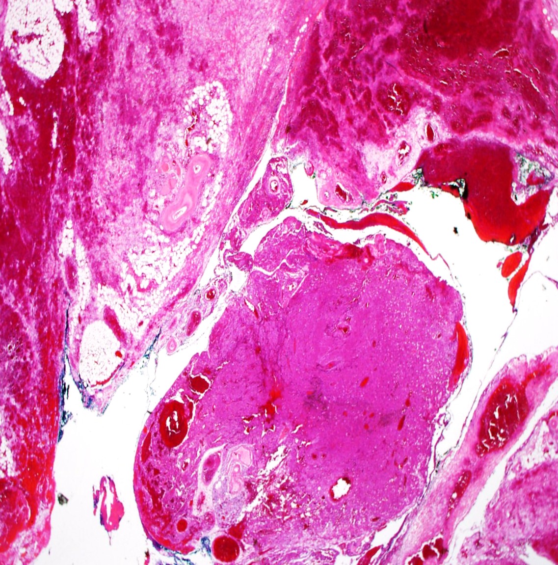 A Rare Cause of Airway Collapse: Spontaneous Hemorrhage and Rupture of a Parathyroid Adenoma