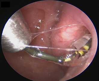 First Report on Shockwave Tubodilation Technique for Eustachian Tube Dysfunction