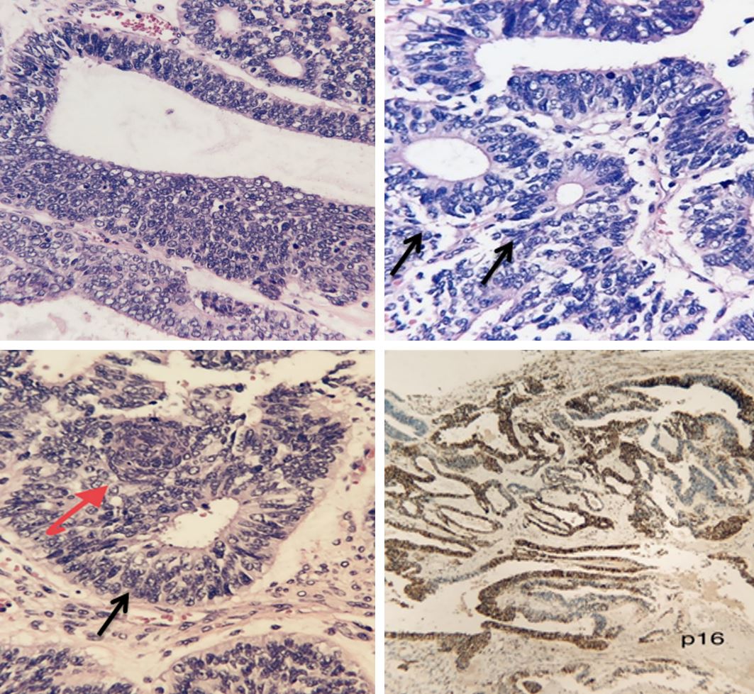 A Rare Case of High-Grade Non-intestinal Sinonasal Adenocarcinoma