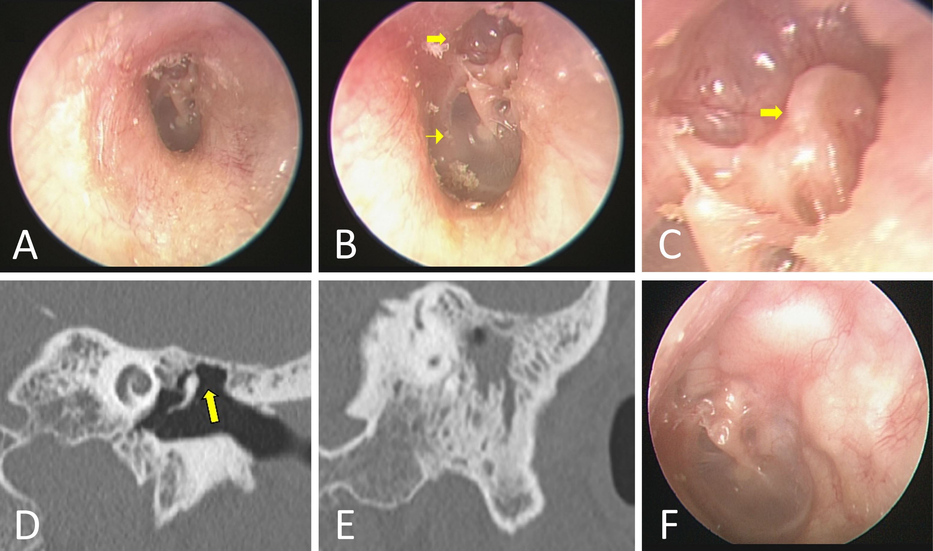 Safe Tympanic Retraction May Be Unsafe: A False Sense of Security in a Patient with Cholesteatoma