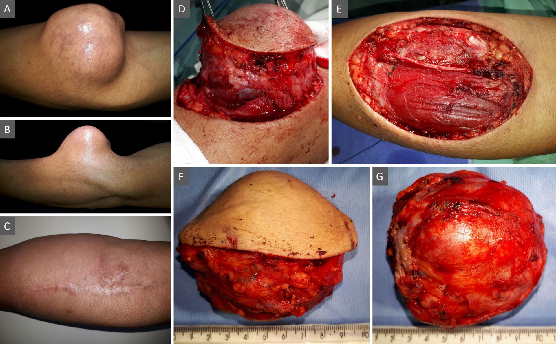 Forearm High-Grade Fibrosarcoma