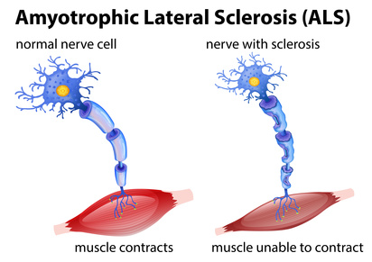 How Stephen Hawking Defied Amyotrophic Lateral Sclerosis for Five Decades