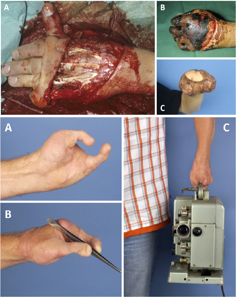 Staged Hand Salvage and Reconstruction with Three Free Tissue Transfers: A Ten-year Follow-up
