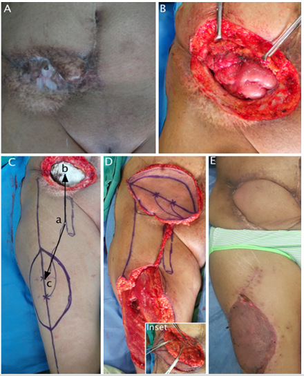 The Versatility of Pedicled Anterolateral Thigh Flap: A Tertiary Re-ferral Center Experience from India