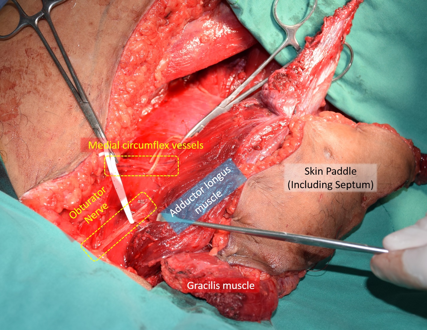 Double Functioning Free Muscle Transfer as a Salvage Procedure for Brachial Plexus Injury After Failed Nerve Transfer