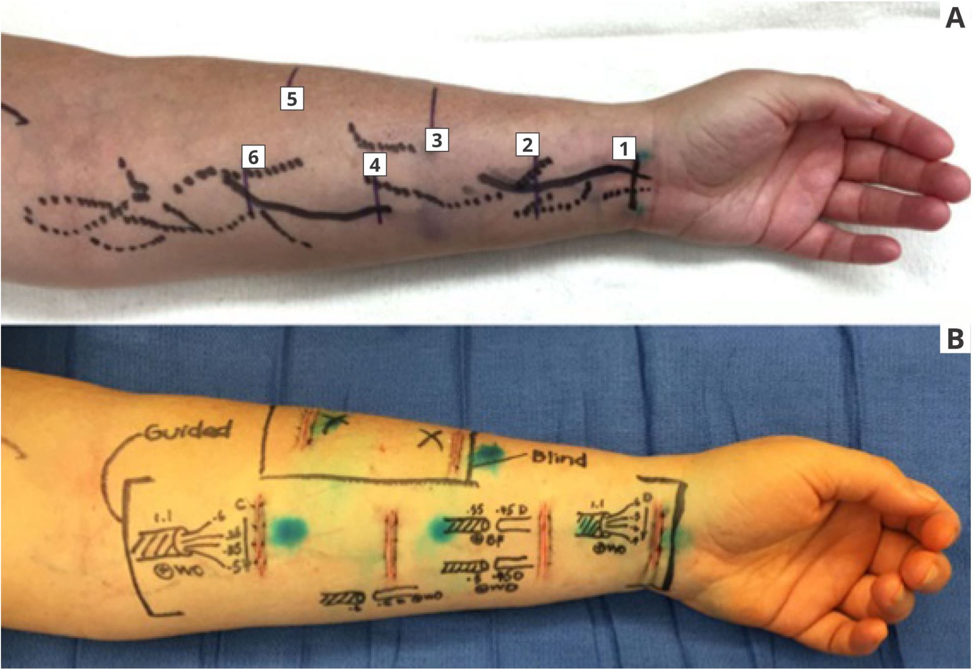 Strategic Incision Placement to Facilitate Successful Supermicrosurgical Lymphaticovenular Anastomoses