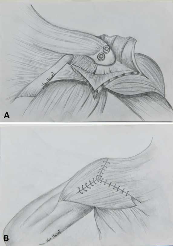 Role of Trapezius Transfer for Shoulder Reconstruction in Adult Traumatic Brachial Plexus Injuries: Literature Review