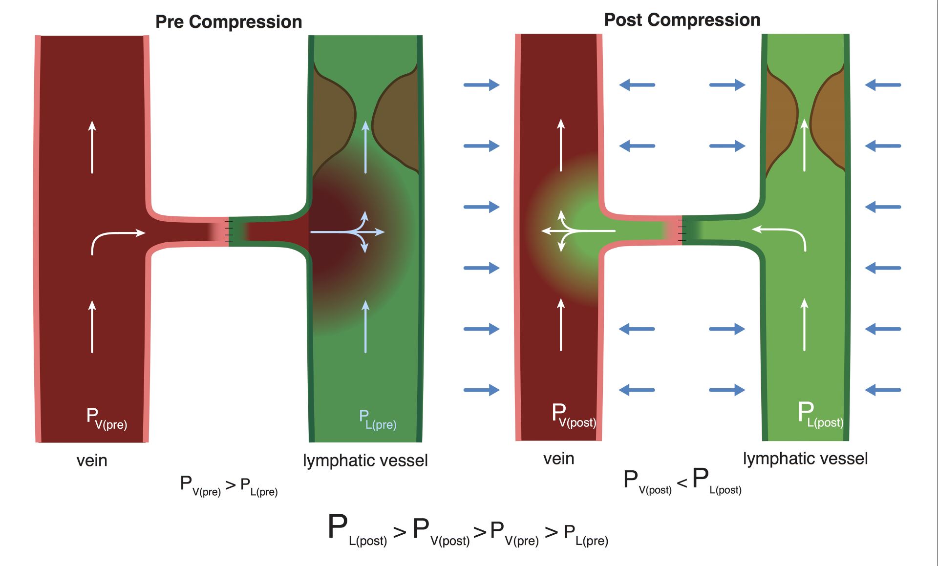 Immediate Limb Compression Following Supermicrosurgical Lymphaticovenular Anastomosis – Is It Helpful or Harmful?