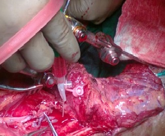A Low Cost Microsuction Tip Cannula in Microvascular Surgery