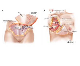 Microsurgical Flaps in Nipple Sparing Mastectomy: Surgical Techniques and Aesthetic Principles
