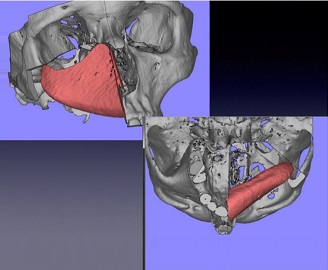 Computer-Assisted Reconstruction of the Hemimaxillectomy Defects With a Composite Iliac Crest Bone Free Flap: Case Reports