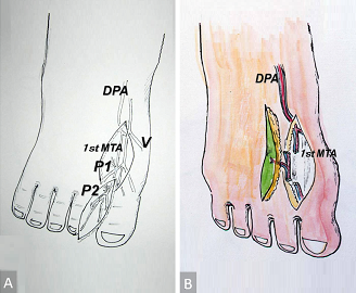 First Metatarsal Artery Capillary Perforator Flaps