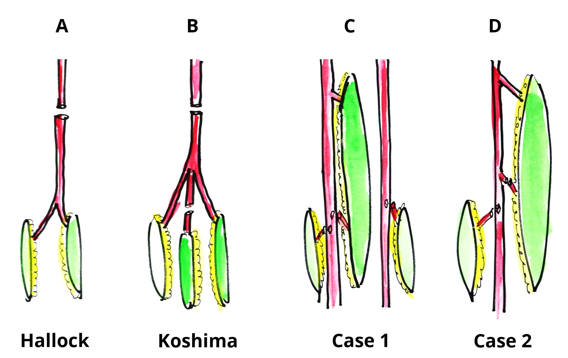 The ‘Orochi’ Flap Concept: Multi-Stage Combined Flap Using Sequential Flaps