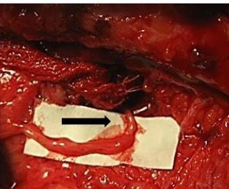 Dynamic Reanimation of Smile in Facial Paralysis With Gracilis Functioning Free Muscle Flap Innervated By Masseteric Nerve: The First Vietnamese Series