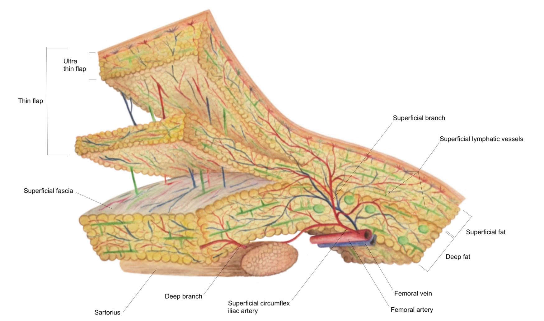 Vascularized Lymph Vessel Transfer for Extremity Lymphedema - Is Transfer of Lymph Node Still Necessary?