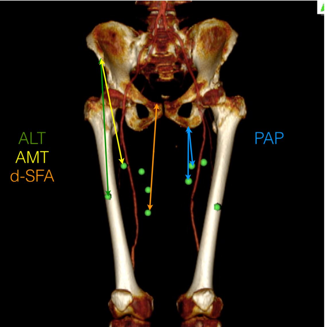 Comprehensive Analysis of Profunda Artery Perforator Flap Thickness Based on CTA