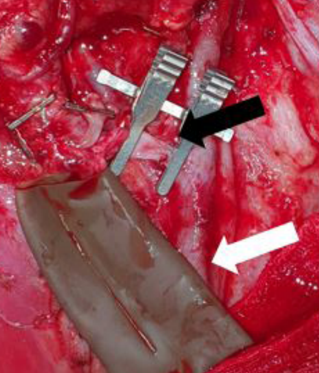 An Innovative Technique to Maintain a Clear Surgical Field During Venous Anastomosis in Free Flap Transfer for Head and Neck Reconstruction
