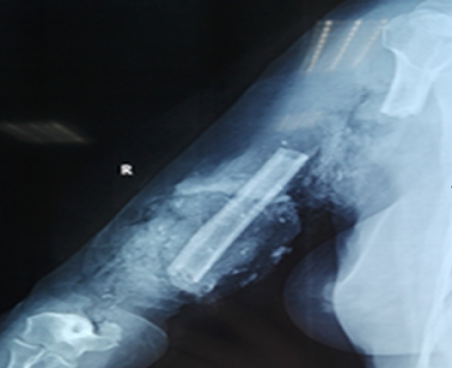 Survival Analysis of Upper Arm Replantation After Avulsion Injuries