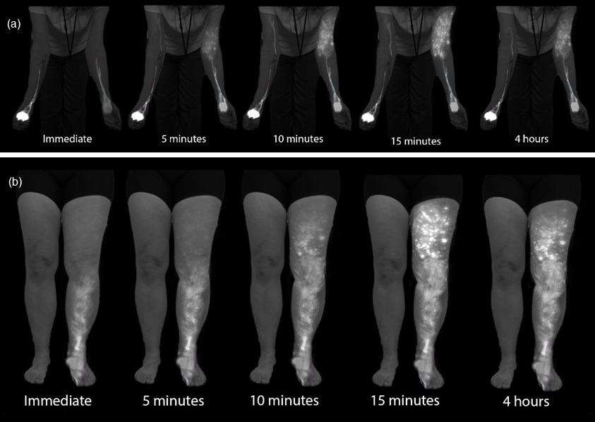 Exercise-Enhanced ICG Lymphography: A Fast Approach to Diagnosis and Staging of Lymphedema