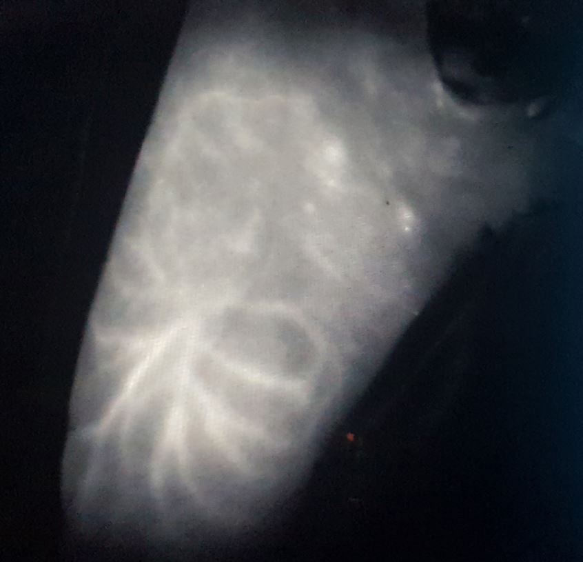 Indocyanine Green Angiography in Salvage Planning: From Pedicled Supraclavicular Flap to Free Supraclavicular Flap