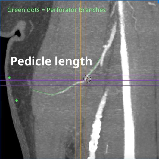 The Thin Profunda Artery Perforator Flap: Customized Design and Harvest