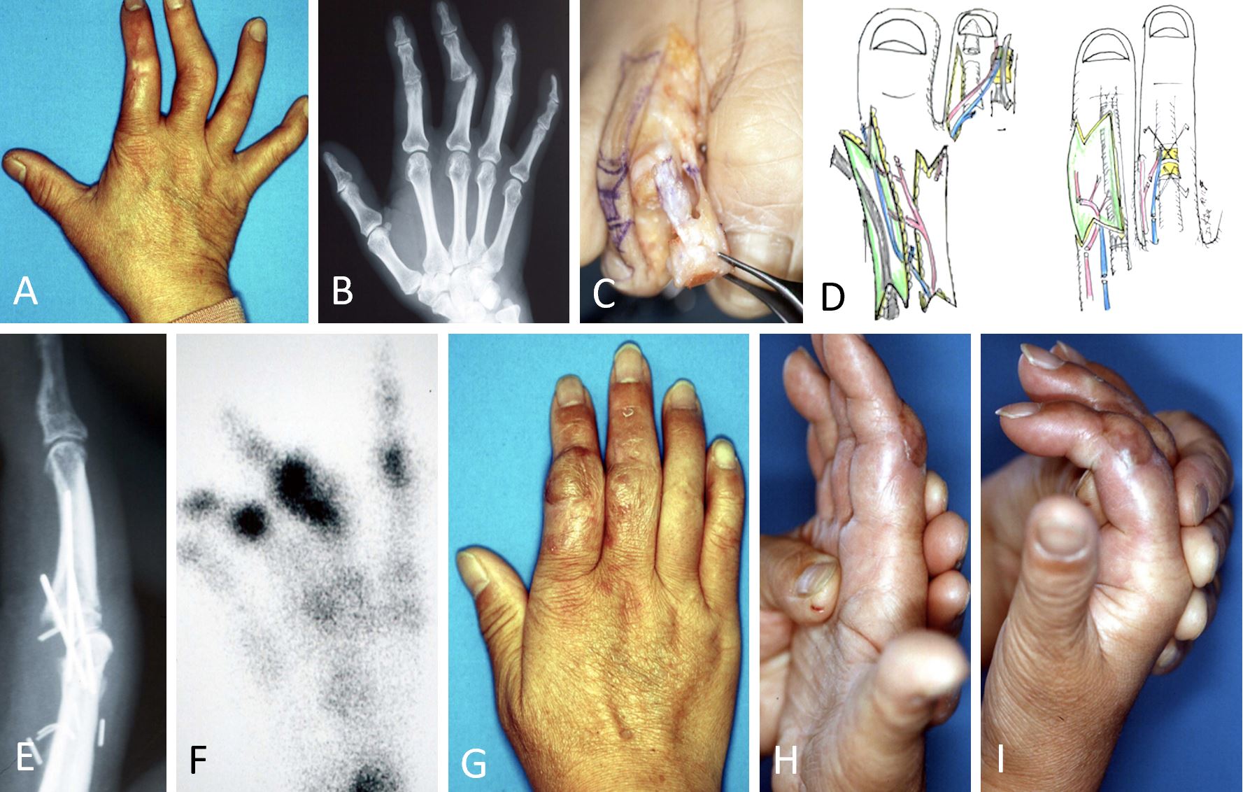 Free Vascularized Second-Toe Distal Interphalangeal Joint Transfer for Reconstruction of Finger Defects