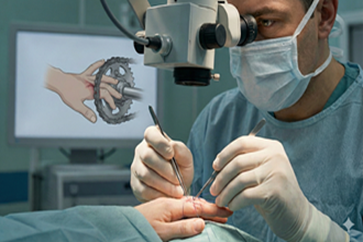 Supermicrosurgical Replantation for Motorcycle Chain-Induced Fingertip Amputations: A Case Series