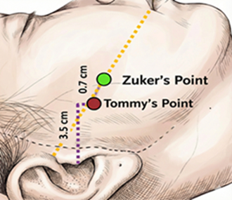 Tommy’s 3-5-7 Method: A Novel Surface-Landmark Technique for Minimally Invasive Identification of the Facial Nerve Buccal Branch