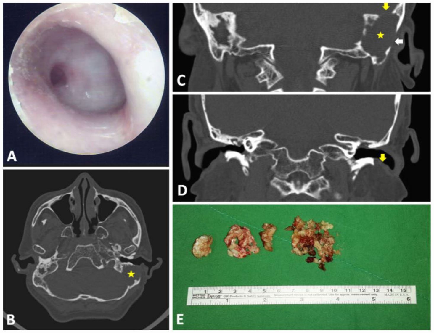 Huge Mastoid Cholesteatoma with Skull Base Erosion and CSF Leak