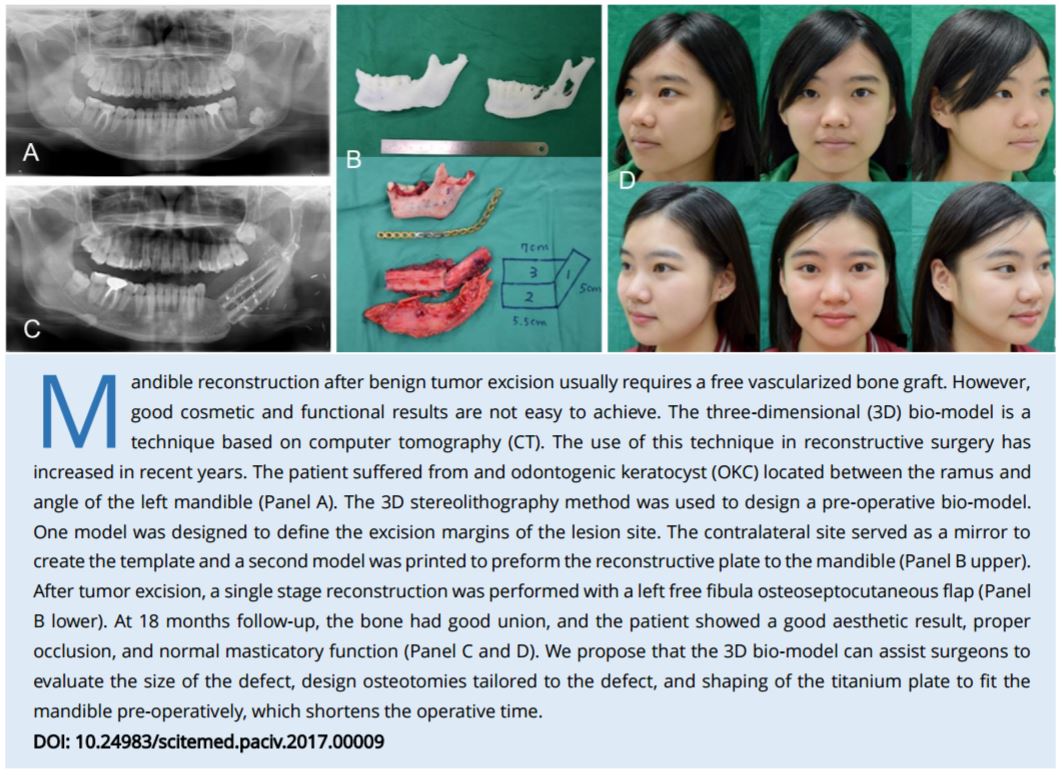 Mandible reconstruction by the assistant of stereolithographic three-dimensional printing model technique